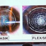 全飞秒内幕劝退！不是所有人都适合做全飞秒！